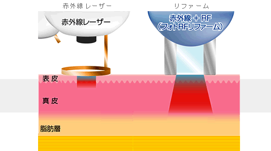 リファームのイメージ