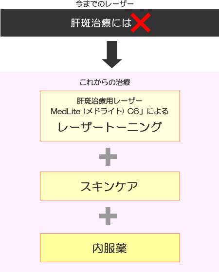 Q-スイッチルビーレーザー照射イメージ